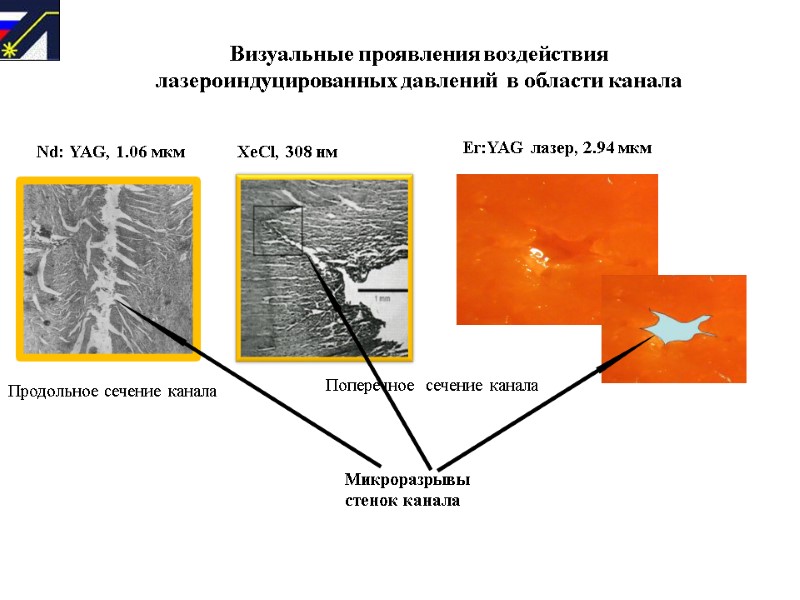 Визуальные проявления воздействия  лазероиндуцированных давлений  в области канала    